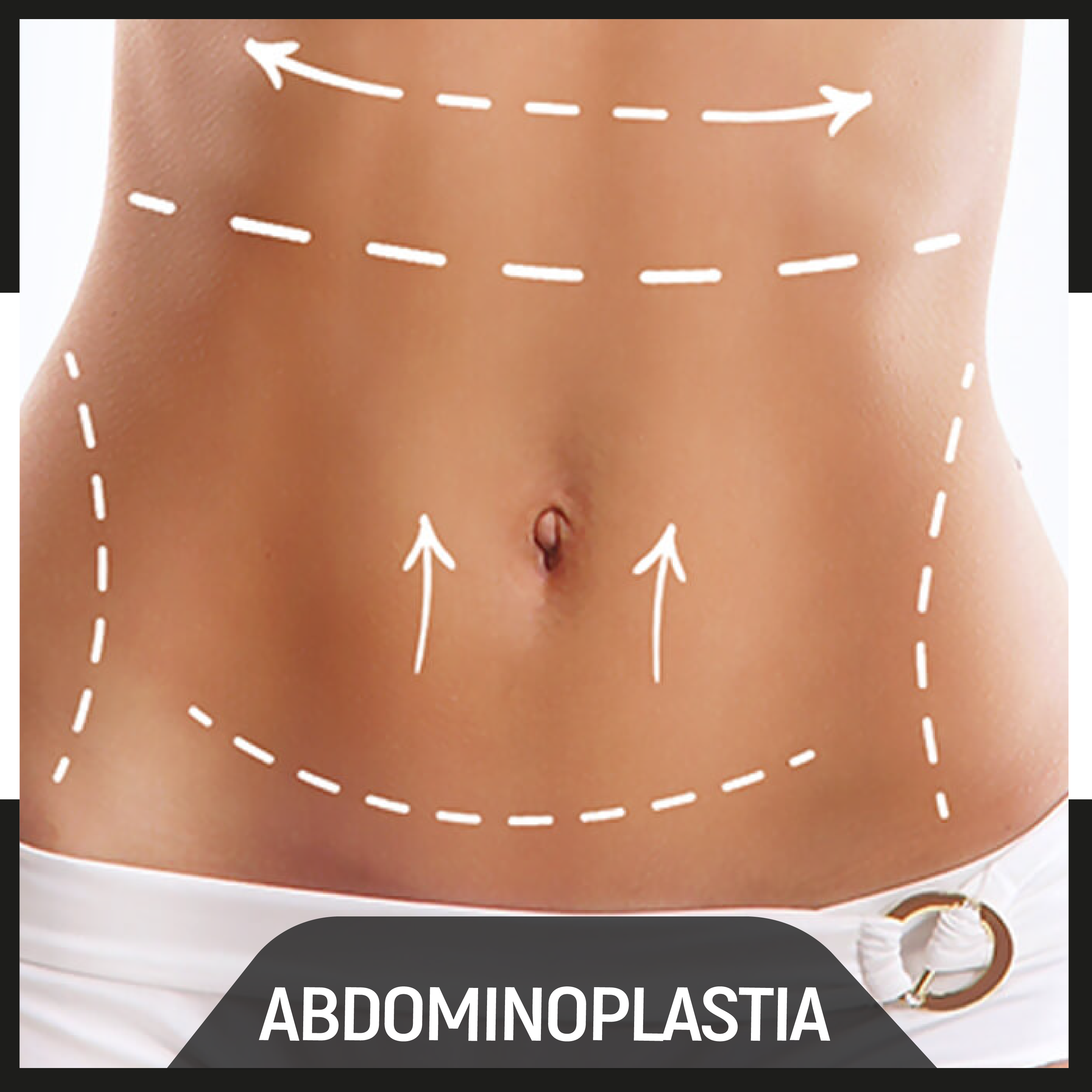 casos sobre abdominoplastia