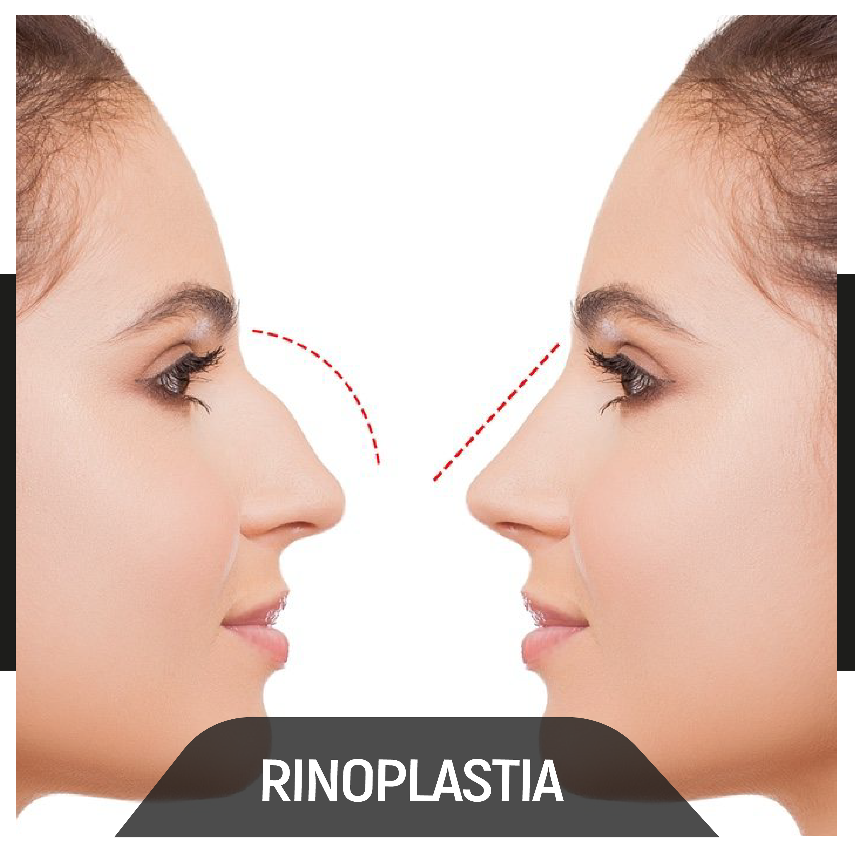 casos de rinoplastia