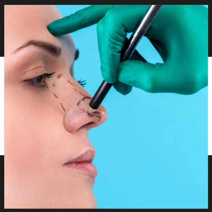 cirugia de rinoplastia